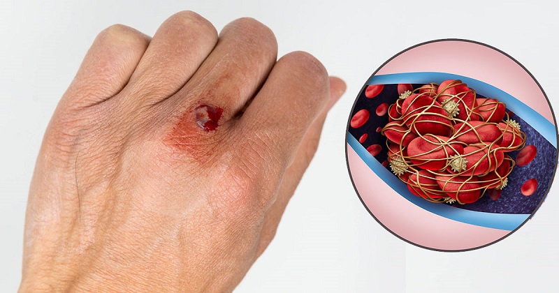 Vitamin K đóng vai trò to lớn trong quá trình làm đông máu. (Ảnh: Sưu tầm Internet)