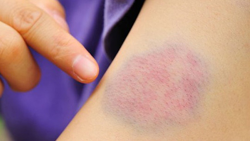 Tình trạng xuất huyết dưới da do thiếu vitamin K. (Ảnh: Sưu tầm Internet)