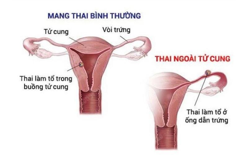Mang thai ngoài tử cung có dấu hiệu gì? (Ảnh: Sưu tầm Internet)