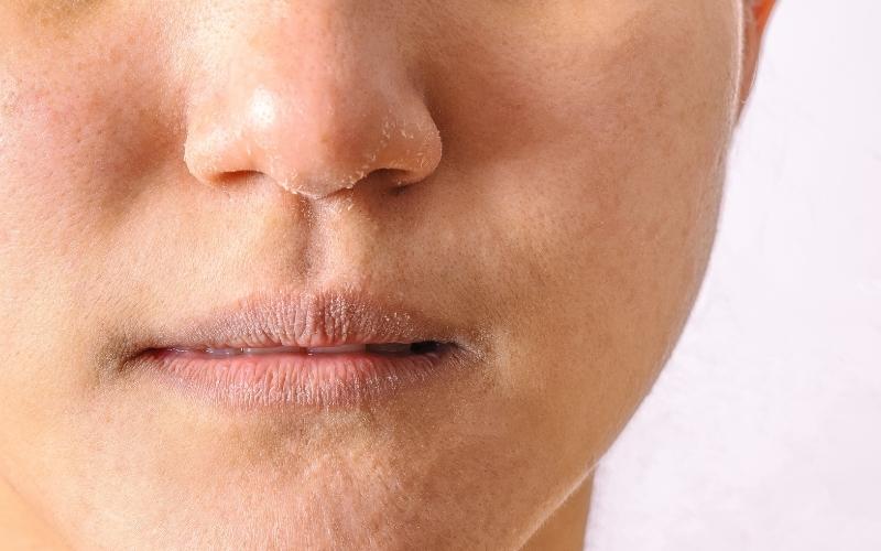 Mẹ bầu da bị khô do thiếu nước nghiêm trọng. (Ảnh: Sưu tầm Internet)