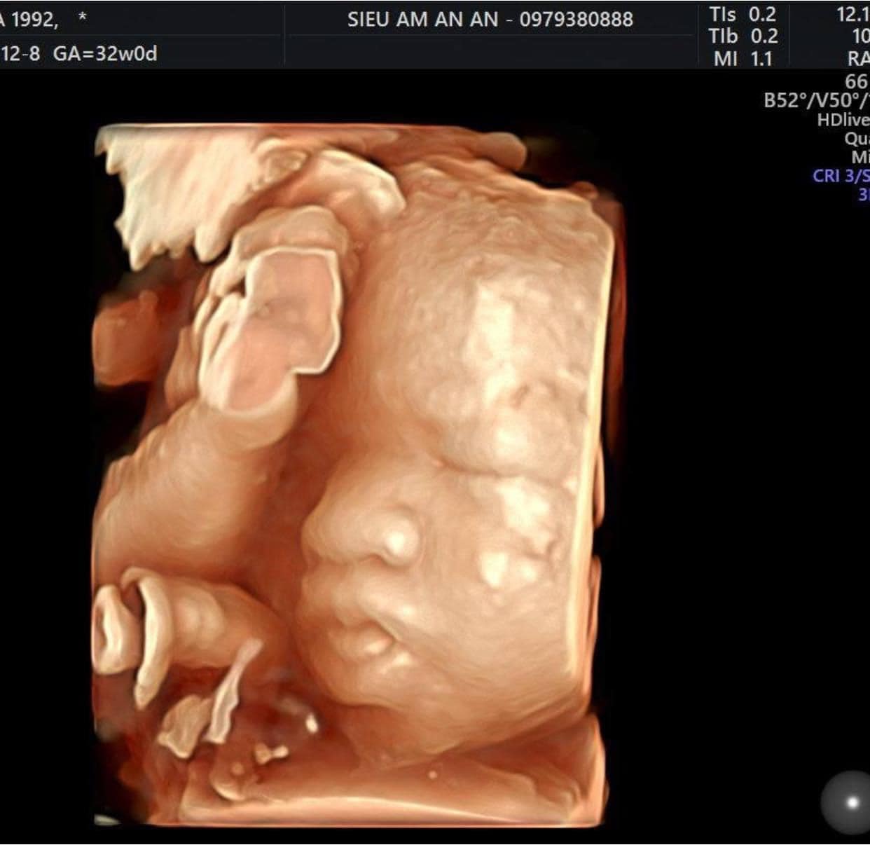 Hình ảnh siêu âm thai nhi 32 tuần. (Ảnh: Sưu tầm Internet)