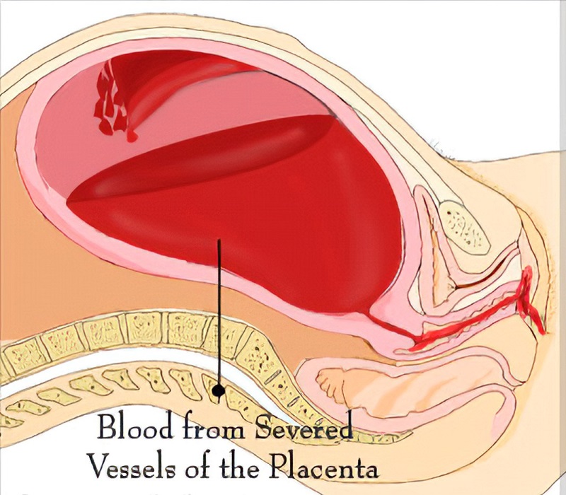 Băng huyết sau sinh là hiện tượng vùng kín chảy máu liên tục (Ảnh: Sưu tầm Internet)