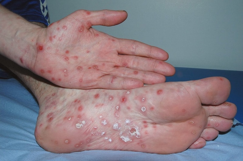 Biểu hiện của người bị bệnh giang mai khi mang thai. (Ảnh: Sưu tầm Internet)