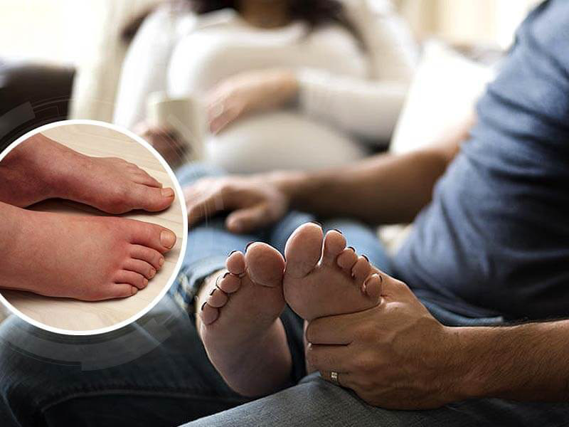 Phù chân là tình trạng thường gặp ở mẹ bầu. (Ảnh: Sưu tầm Internet)