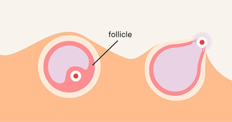 Hiện tượng rụng trứng. (Ảnh: Sưu tầm Internet)