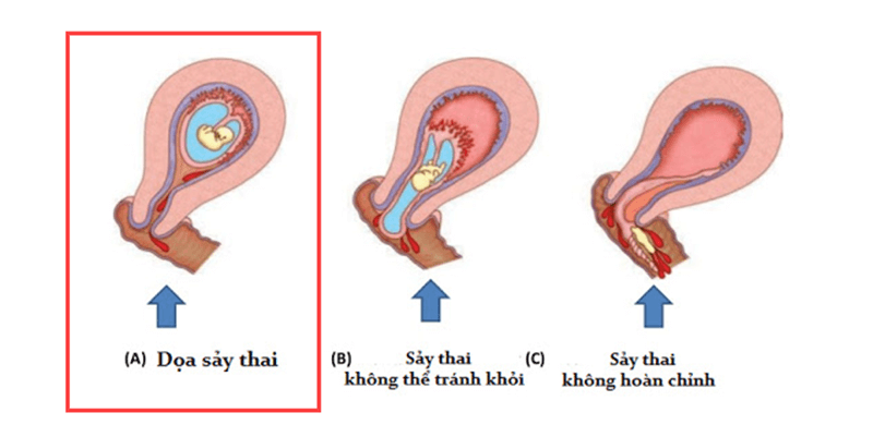 Dọa sảy thai. (Ảnh: Sưu tầm Internet)
