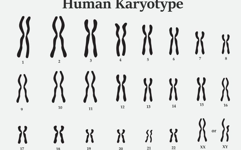 Nhiễm sắc thể ở người mắc hội chứng klinefelter. (Ảnh: Sưu tầm Internet)