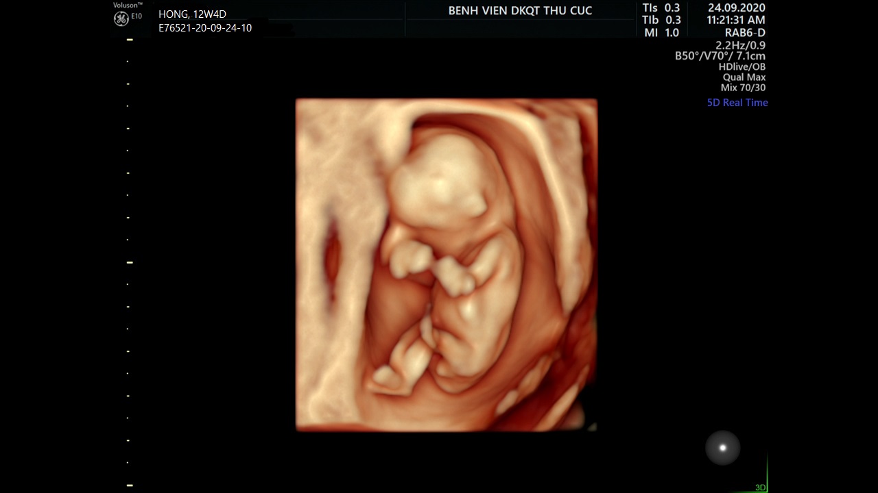 Dấu hiệu thai 12 tuần khỏe mạnh. (Ảnh: Sưu tầm Internet)