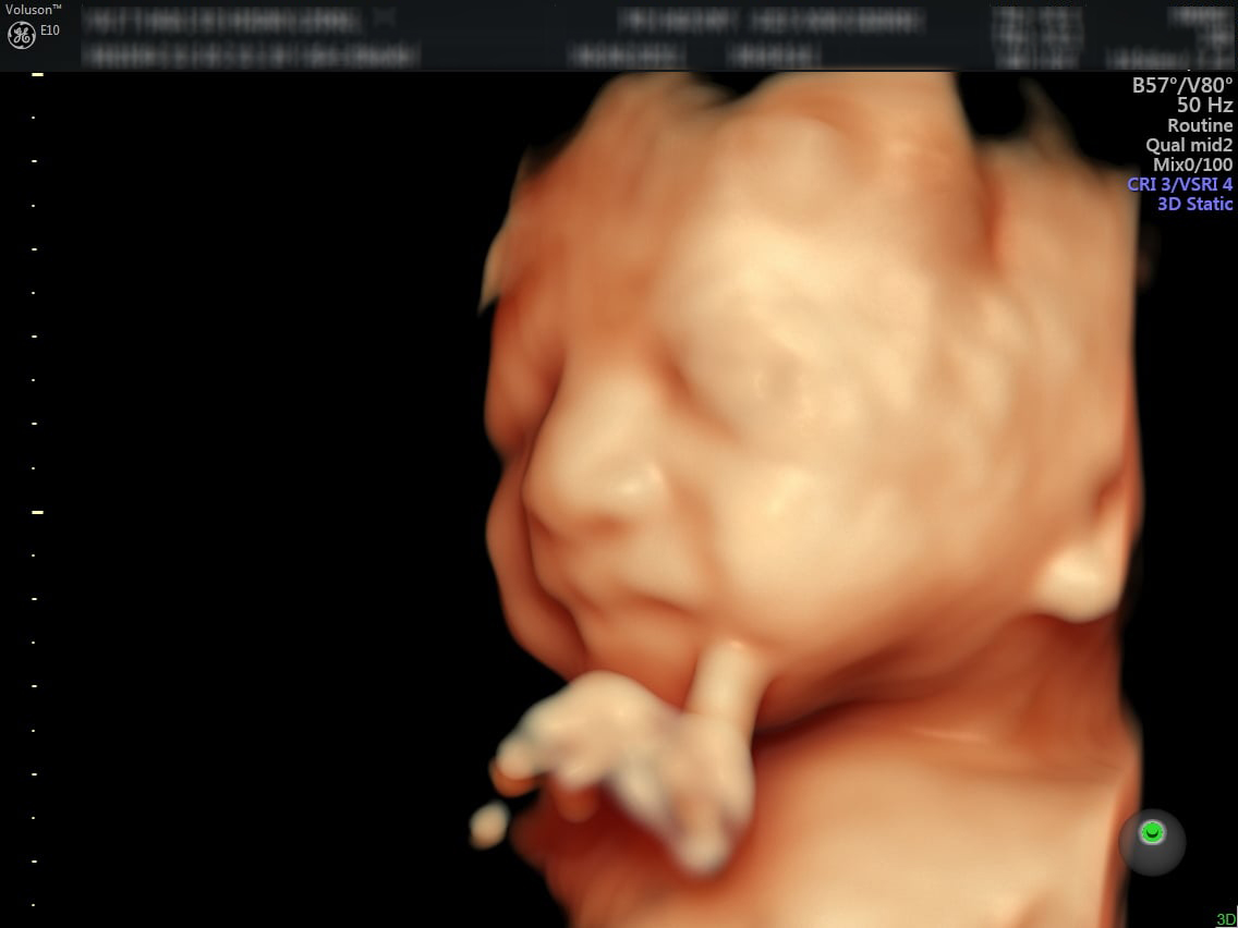 Siêu âm thai nhi 28 tuần. (Ảnh: Sưu tầm Internet)