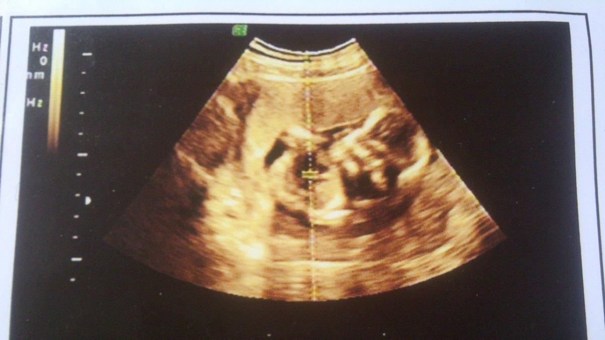 Một số đặc điểm ở thai 6 tuần. (Ảnh: Sưu tầm Internet)