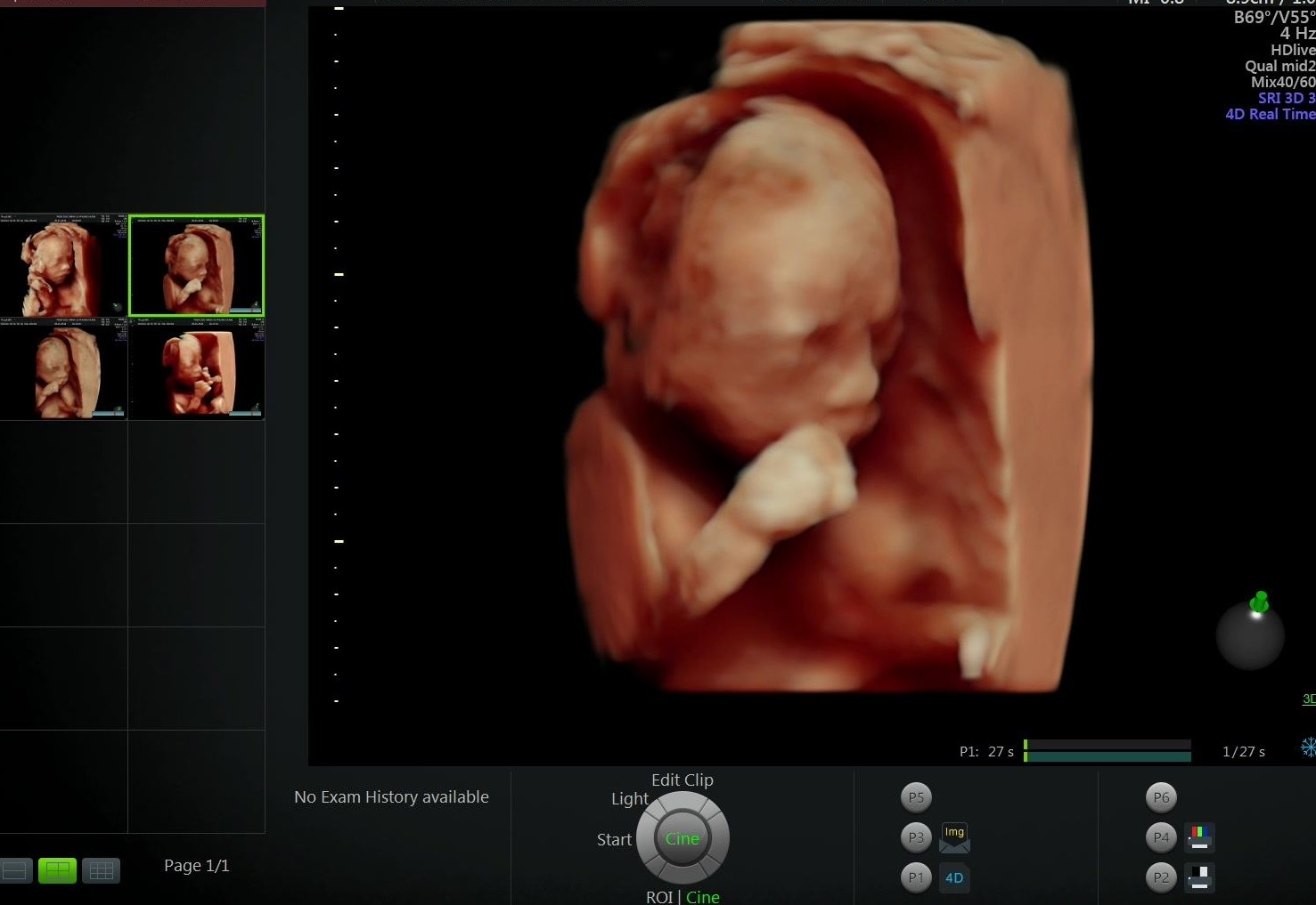 Ảnh siêu âm thai nhi 20 tuần tuổi. (Ảnh: Sưu tầm Internet)