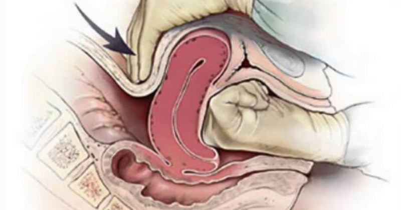 Quá trình thực hiện ép tử cung khi sản phụ có dấu hiệu bị đờ tử cung ( Ảnh: Sưu tầm Internet)