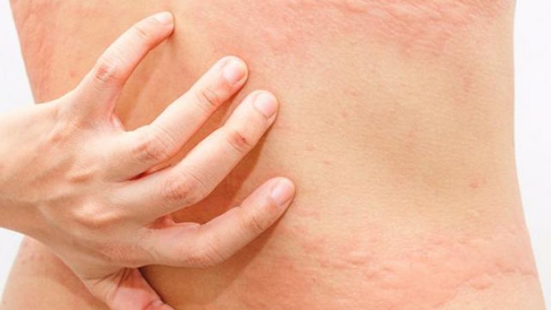 Nổi mề đay khi mang thai là gì? (Ảnh: Sưu tầm Internet)