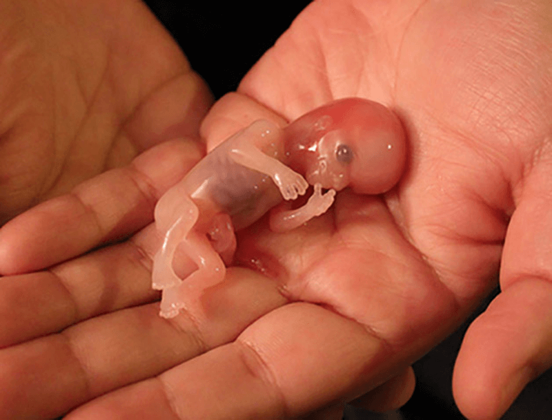 Sảy thai là gì? (Ảnh: Sưu tầm Internet)