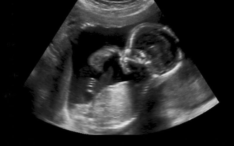 Siêu âm dị tật thai nhi giúp phát hiện những bất thường nhờ sóng âm ghi lại hình ảnh thai trong bụng. (Ảnh: Sưu tầm Internet)