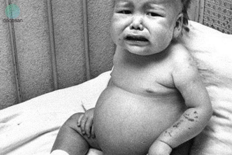 Suy dinh dưỡng thể phù là căn bệnh thường gặp ở trẻ em, khiến nhiều bộ phận bị sưng phù và da bị rối loạn sắc tố nặng nề. (Ảnh: Sưu tầm Internet)