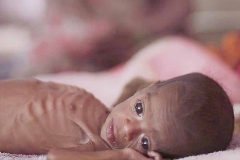 Trẻ em mắc chứng suy dinh dưỡng thể teo đét có ngoại hình còi cọc, gầy trơ xương. (Ảnh: Sưu tầm Internet)