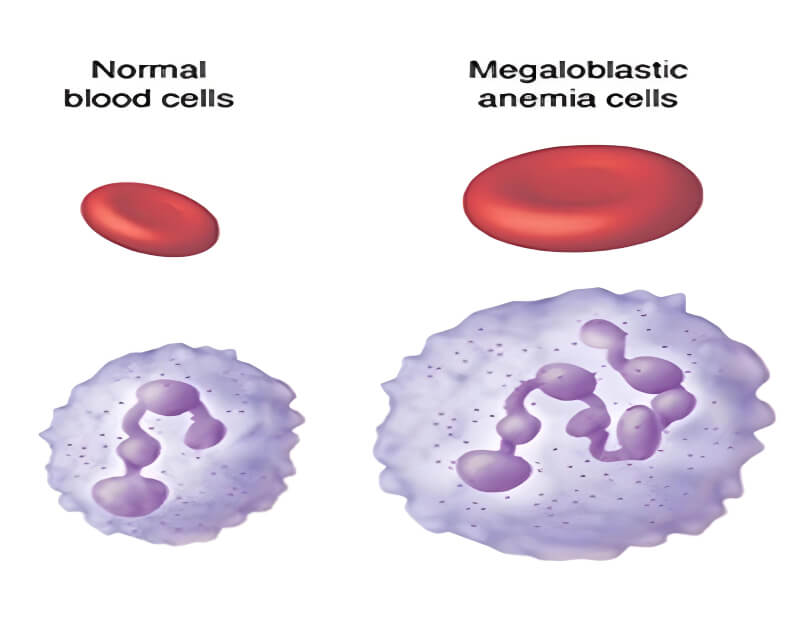 Thiếu máu hồng cầu khổng lồ. (Ảnh: Sưu tầm Internet)