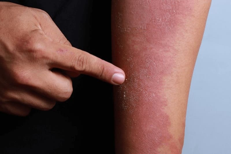 Các vùng da bị mẩn đỏ do thiếu vitamin PP.  (Ảnh: Sưu tầm Internet)