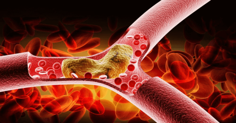 Mỡ máu cao. (Ảnh: Sưu tầm Internet)