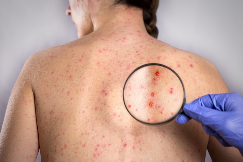 Rubella là bệnh gì? (Ảnh: Sưu tầm Internet)