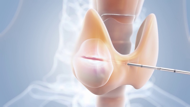 Tỷ lệ phụ nữ bị u tuyến giáp cao hơn nam giới. (Ảnh: Sưu tầm Internet)