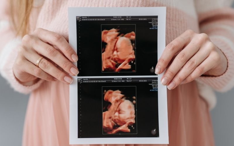 Xét nghiệm dị tật thai nhi giúp phát hiện sớm những bất thường trước sinh. (Ảnh: Sưu tầm Internet)