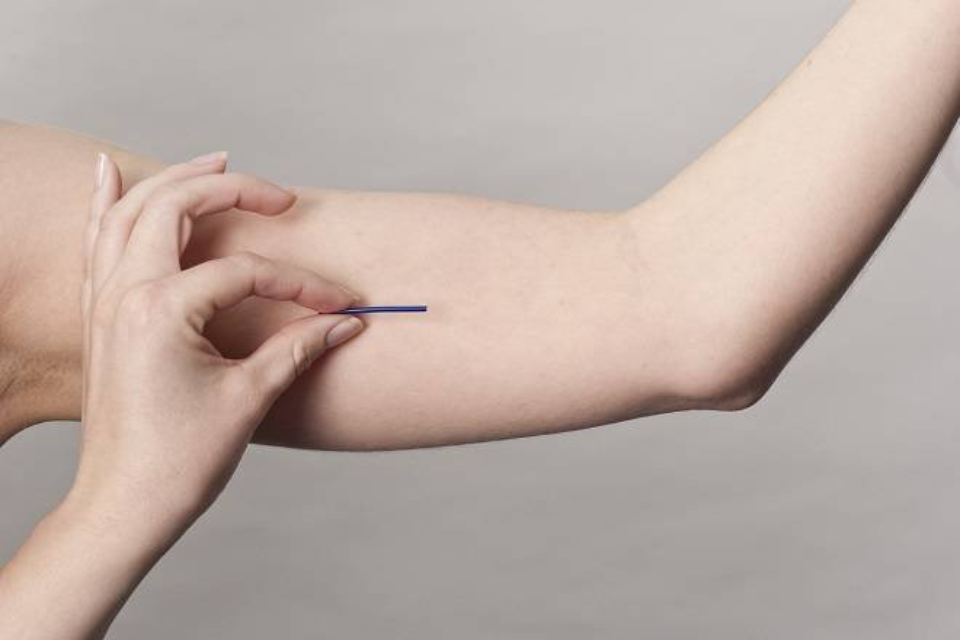 Phương pháp tránh thai cấy que tiện lợi, tiết kiệm được rất nhiều mẹ bỉm yêu thích (Ảnh: Sưu tầm Internet)