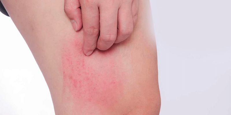 Không được chọc bể bóng nước và không được gãi lên vết thương (Ảnh: Sưu tầm internet)