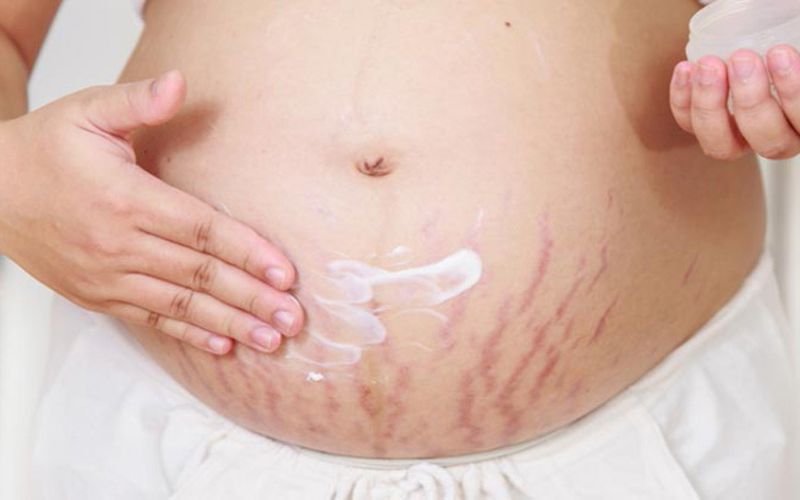 Dùng kem dưỡng giúp cải thiện rạn da. (Ảnh: Sưu tầm Internet)