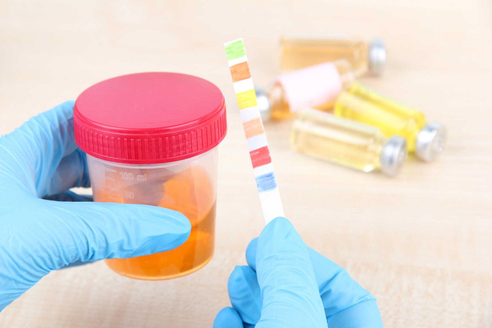 Xét nghiệm nước tiểu được thực hiện trong tuần này. (Ảnh: Sưu tầm Internet)
