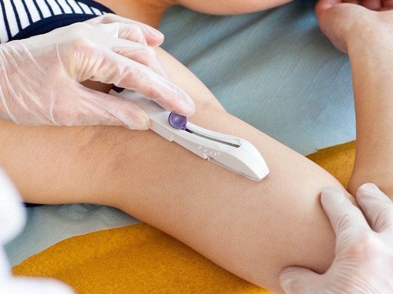 Phương pháp cấy que tránh mang thai (Ảnh: Sưu tầm Internet)