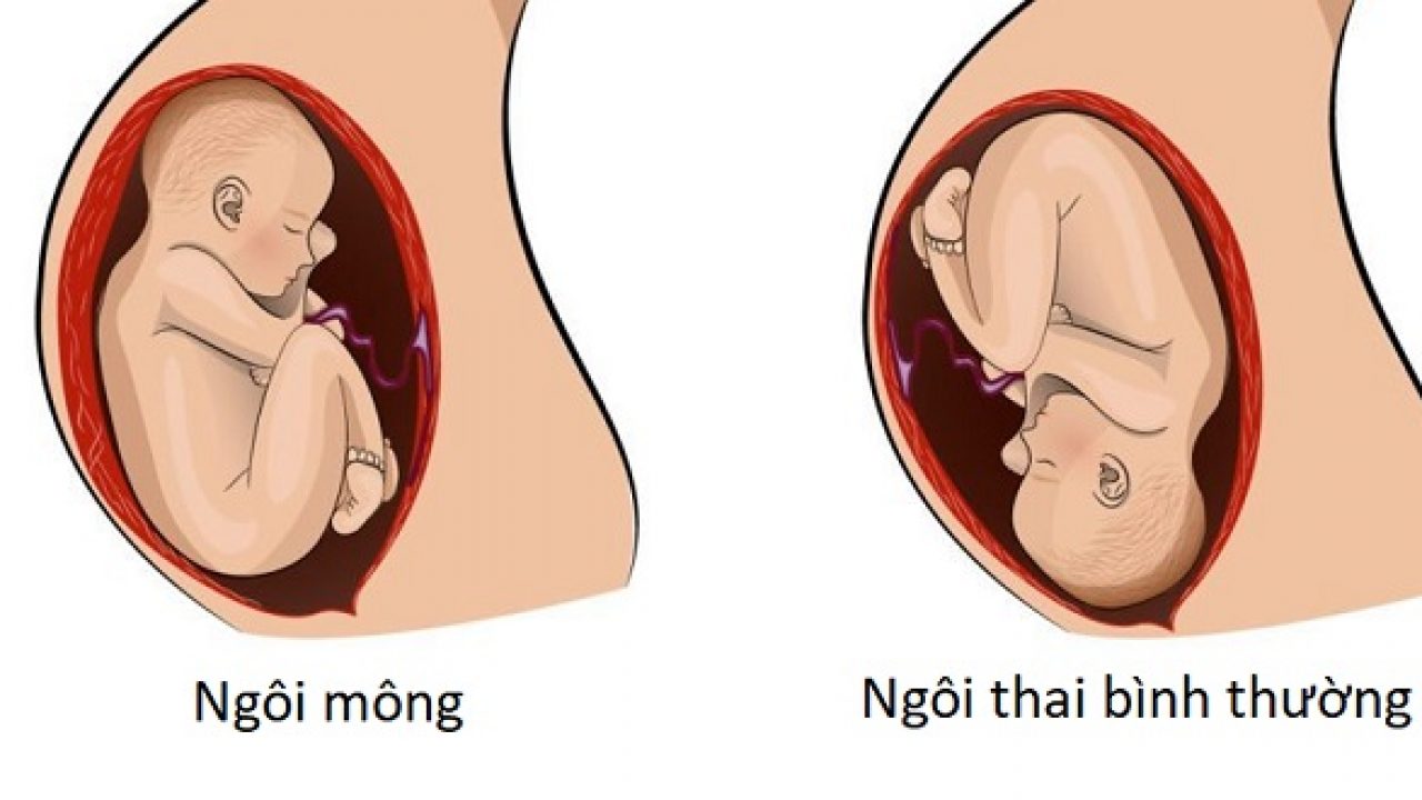 Ngôi thai của em bé trong bụng rất quan trọng. (Ảnh: Sưu tầm Internet)