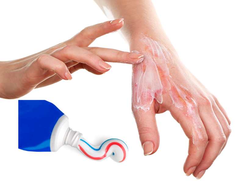 Nếu bôi kem đánh răng vào vùng da bị bỏng do bô xe sẽ làm mức độ đau rát cao hơn (Ảnh: Sưu tầm internet)