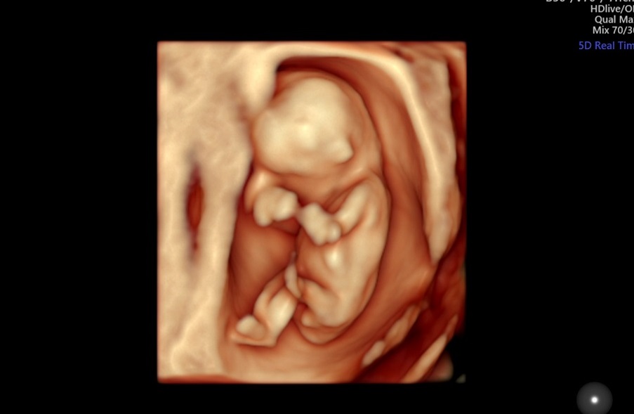 Hình ảnh siêu âm thai. (Ảnh: Sưu tầm Internet)