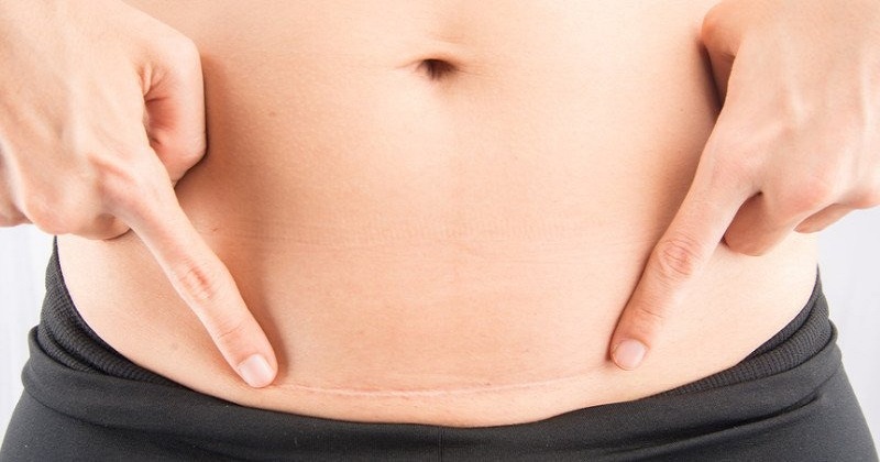 Mẹ hãy vệ sinh vết mổ bằng dung dịch Povidine 10% hoặc Betadine (Ảnh: Sưu tầm Internet)