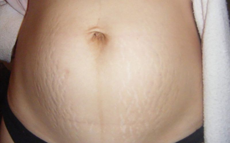 Xuất hiện các vết lõm hoặc gờ nhẹ trên da là dấu hiệu bị rạn da. (Ảnh: Sưu tầm Internet)