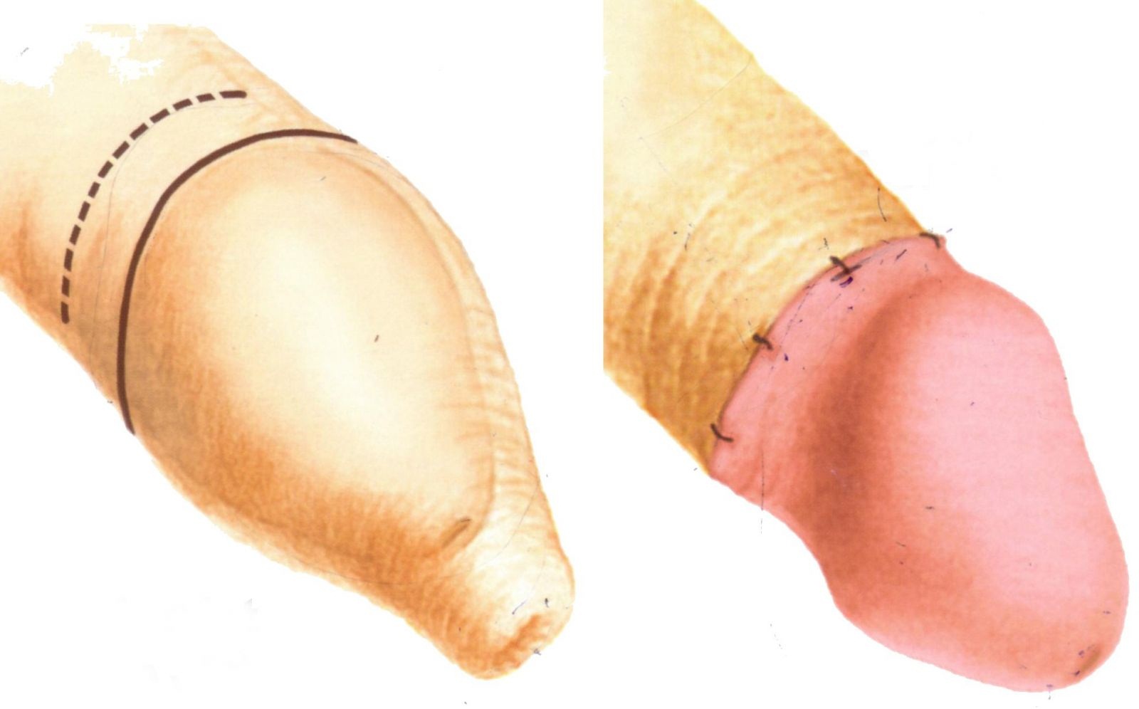 Hiện tượng dài bao quy đầu là gì? (Ảnh: Sưu tầm Internet)