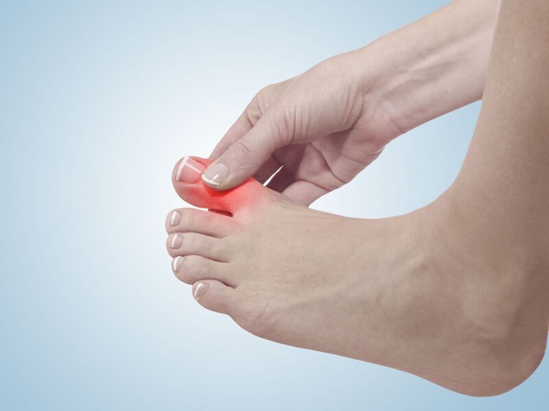 Đau khớp xương ngón cái - Dấu hiệu Gout. (Ảnh: Sưu tầm Internet)