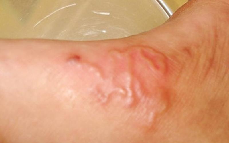 Sán chó làm tổ dưới da người. (Ảnh: Sưu tầm Internet)