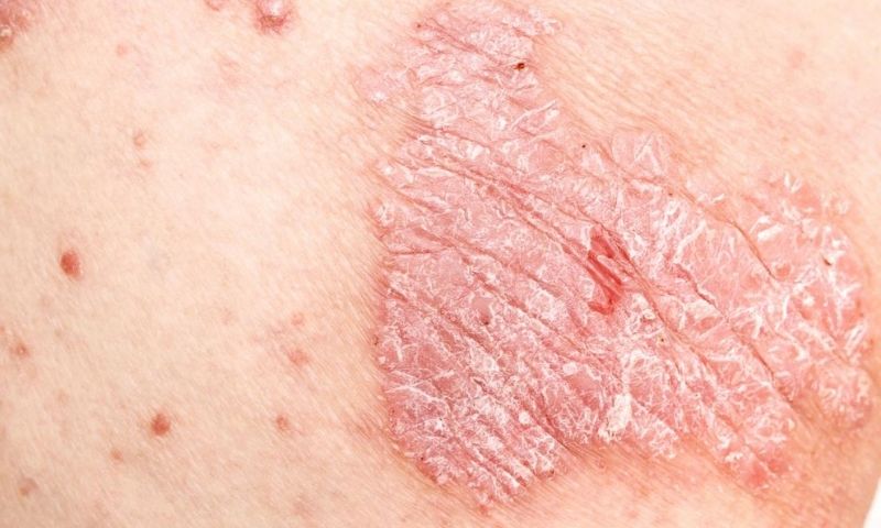 Mẹ bầu bị vảy nến khi mang thai không thoải mái khi giao tiếp. (Ảnh: Sưu tầm Internet)