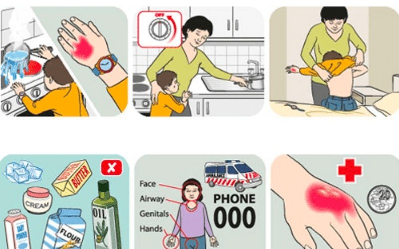 Nguyên tắc chung trong cách xử lý khi trẻ bị bỏng hơi (Ảnh: Sưu tầm internet)