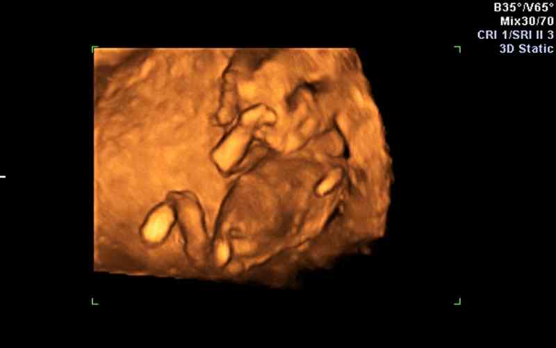 Hình ảnh siêu âm thai nhi 3 tháng giữa. (Ảnh: Sưu tầm Internet)