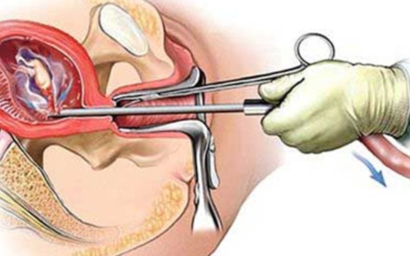 Trung bình khoảng 3-4 tuần sau hút thai các mẹ sẽ rụng trứng trở lại (Ảnh: Sưu tầm Internet)