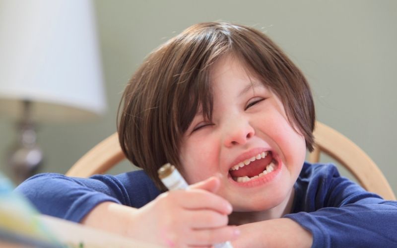 Trẻ bị bệnh Down bẩm sinh. (Ảnh: Sưu tầm Internet)