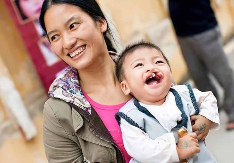 Trẻ bị dị tật bẩm sinh sứt môi, hở hàm ếch. (Ảnh: Sưu tầm Internet)