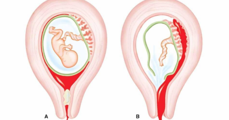 Vỡ tử cung là tình trạng tổn tương đường sinh dục nặng ở sản phụ ( Ảnh: Sưu tầm Internet)