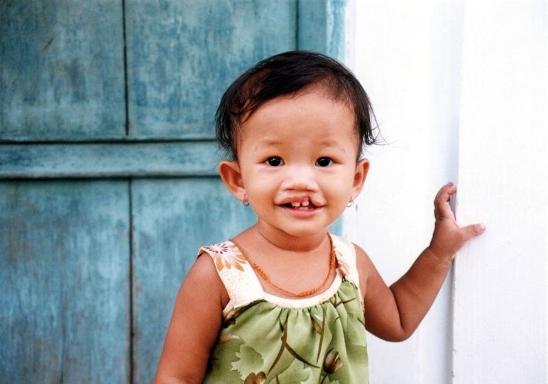 Dị tật hở hàm ếch do yếu tố di truyền và môi trường gây nên. (Ảnh: Sưu tầm Internet)