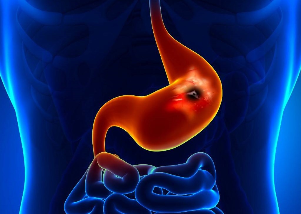 Viêm loét dạ dày. (Ảnh: Sưu tầm Internet)