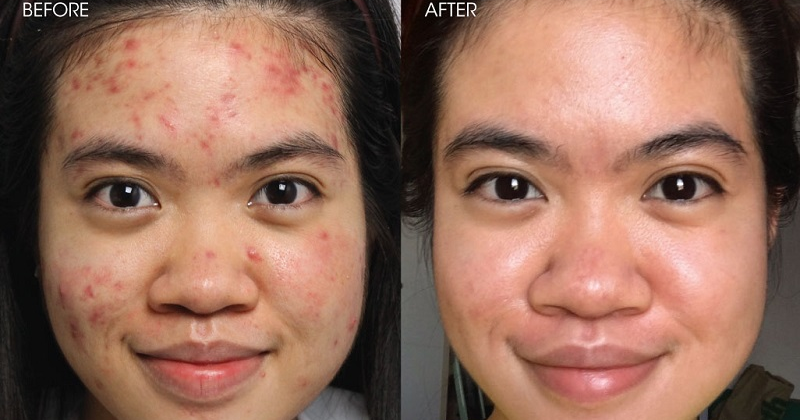 Công dụng chính của Retinol là trị mụn và chống lão hóa (Ảnh: Sưu tầm Internet)